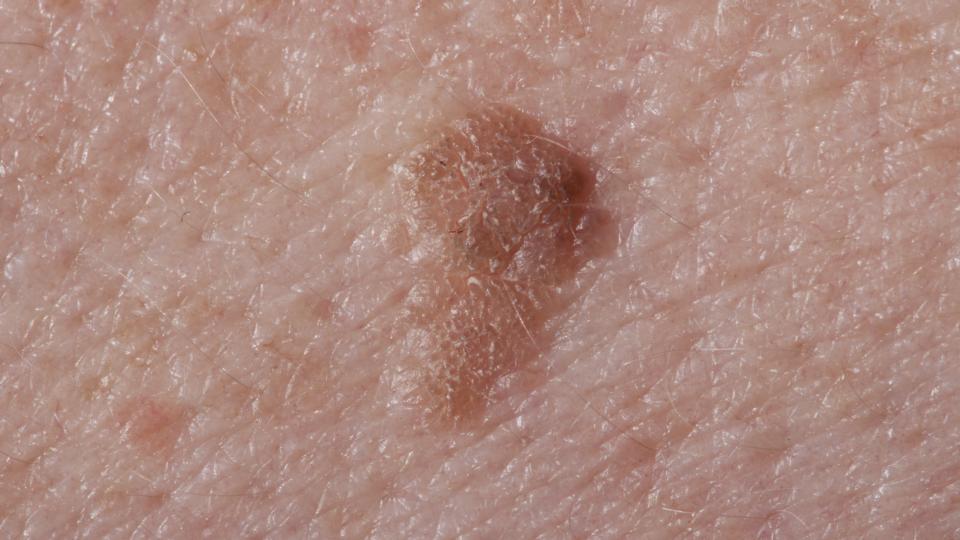 On Beauty Deal With Your Liver Spots Without Resorting To Laser Treatment