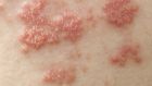 Shingles is characterised by a painful rash, usually on one side of the body and most often on the trunk or torso. Photograph: Thinkstock