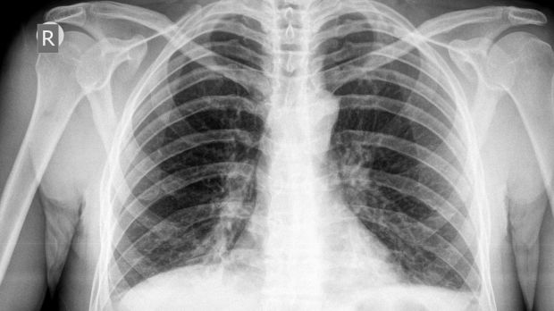 Tuberculosis discovery: The findings, related to a gene known as MAL, could lead to personalised treatments for those who develop TB. Photograph: Thinkstock