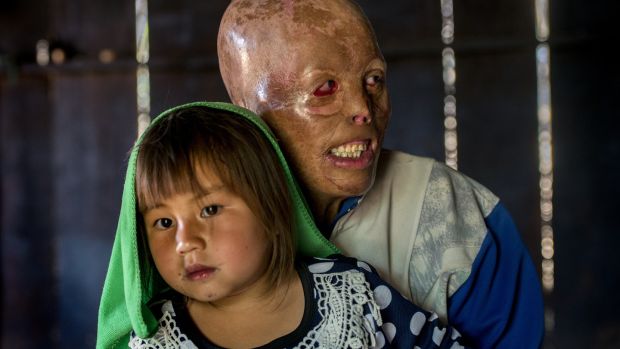 Yeyang Yang, aged 31, with his daughter Syya (6) at their home in Banxang village, Phonsavan, Laos. He was burning rubbish when the heat of the fire ignited a UXO in the ground and it exploded. Photograph: Brenda Fitzsimons