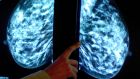  Swiss drugmaker Roche says Perjeta (pertuzumab) would benefit 1,000 breast cancer patients over a five-year period. File photograph: Rui Vieira/PA Wire