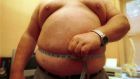 Obesity increases the risk of development of several clinical conditions such as diabetes and cancer. Photograph:  Pozarik/Getty Images