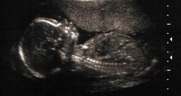An ultrasound image of a  five-month-old foetus. The majority of the Joint Oireachtas Committee on the Eighth Amendment proposed to allow abortion in the first 12 weeks of pregnancy “with no restriction as to reason”.