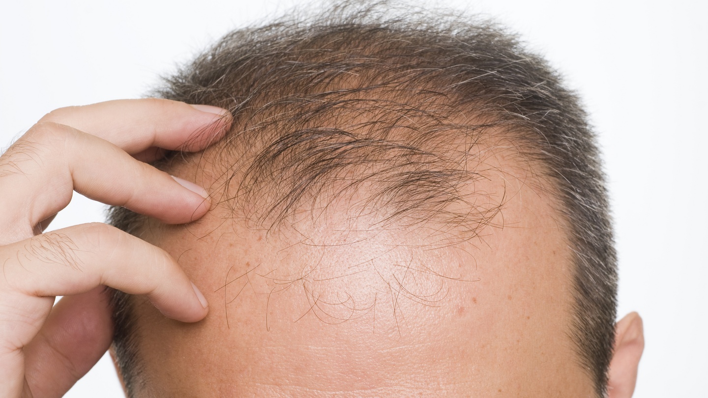 Why Is My Hair Falling Out? Hormones, Medications, and Other Causes