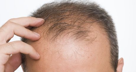 does propecia stop hair loss immediately