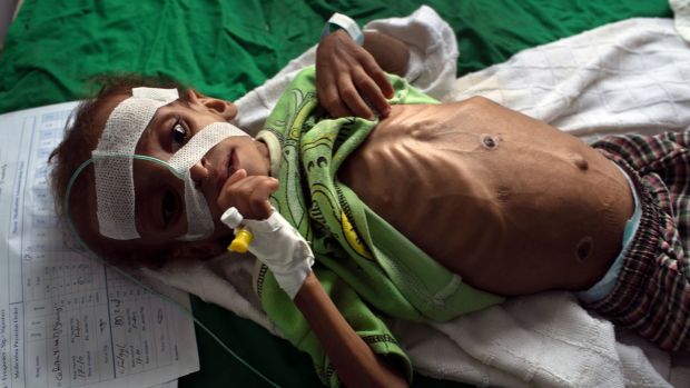 Shaher al-Hajaji (3), who suffers from malnutrition, on a bed at a hospital in Hajjah, Yemen. Photograph: Tyler Hicks/The New York Times