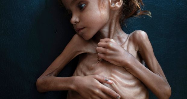 Amal Hussain (7), who suffers from severe acute malnutrition, lies in a bed at a mobile clinic run by Unicef in Aslam, Yemen. Photograph:  Tyler Hicks/The New York Times