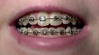 Braces no longer a familiar aspect of adolescence as dentists and orthodontists see the adult’s mouth as just as malleable as the child’s