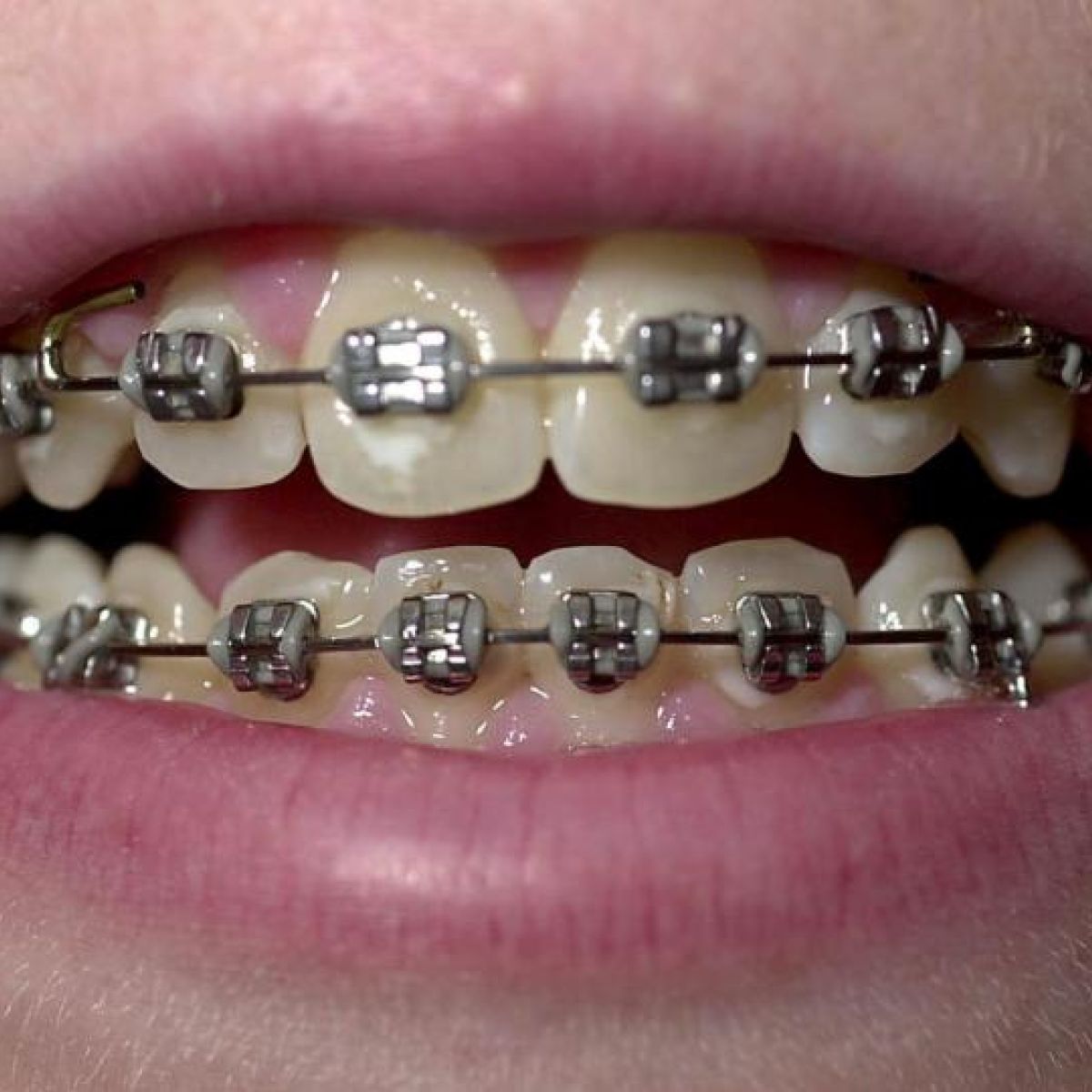 Braces for adults wearing How Long