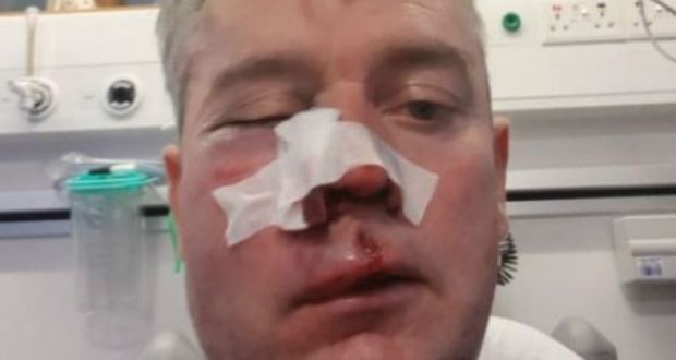 Referee Daniel Sweeney, who is originally from Dungloe, Co Donegal, has a broken jaw and fractured eye socket. He   is unable to talk and can only drink through a straw