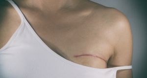 Breast reconstruction is an area where increasingly sophisticated techniques in fat transfer are allowing for more natural and sustainable results. Photograph: iStock