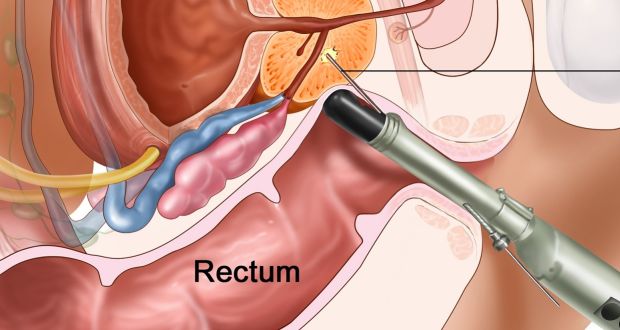 prostate ultrasound procedure proteine ​​în urină din prostatită