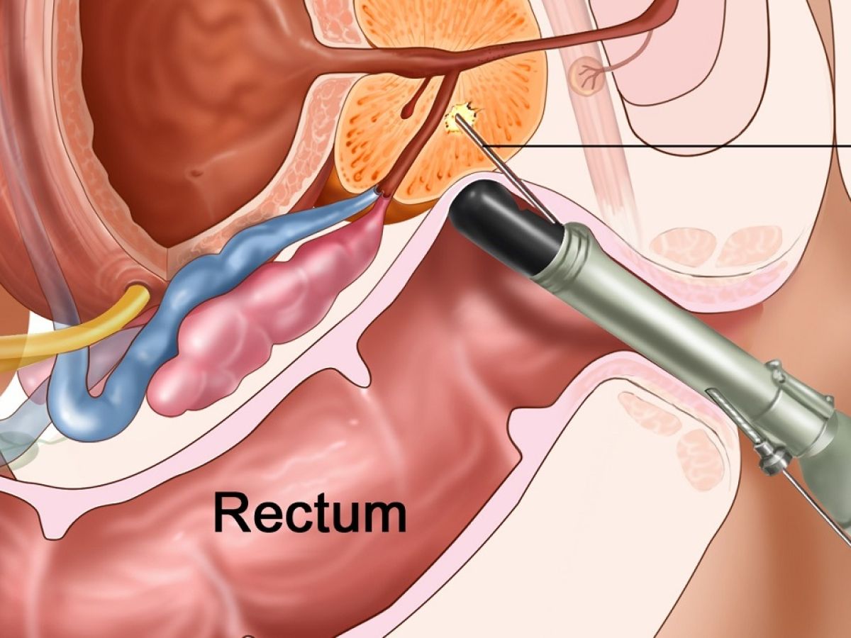 prostate biopsy ppt)