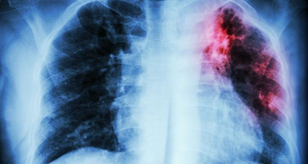 Most TB cases are caused by breathing in bacteria; only a small number of people who breathe in the TB germ get sick, says HSE. Photograph: iStock