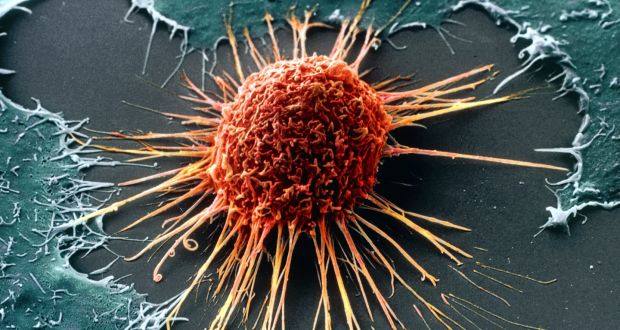 A cervical cancer cell. For every 1,000 women screened for cervical cancer, about 20 will have precancerous changes, but the traditional smear test will pick up only 15 of these.