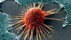 A cervical cancer cell. For every 1,000 women screened for cervical cancer, about 20 will have precancerous changes, but the traditional smear test will pick up only 15 of these.