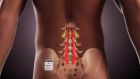 ReActiv8 is an implantable restorative neurostimulation system designed to treat disabling chronic low back pain.