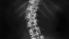 A dedicated telephone line has been established for parents and guardians who have queries in relation to their child’s scoliosis treatment/surgery at Crumlin hospital. Photograph: iStock