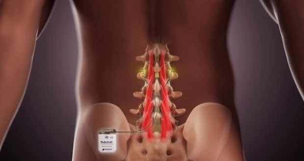  Mainstay’s ReActiv8 device  is used to treat chronic back pain