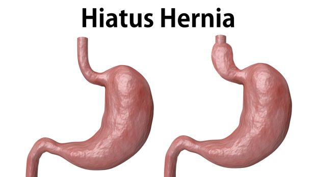 The hiatal hernia is the advancement of part of the stomach towards the esophagus.