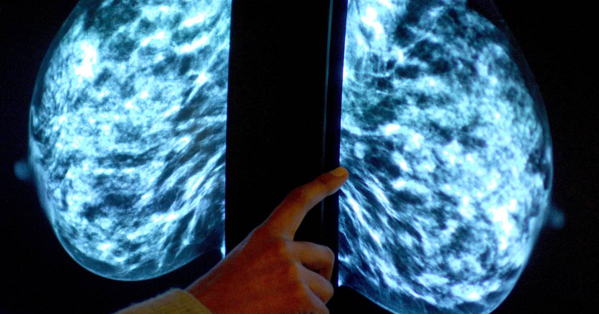 Le dépistage du cancer du sein « ne fait pas beaucoup de différence » sur les taux de mortalité, selon un oncologue – The Irish Times