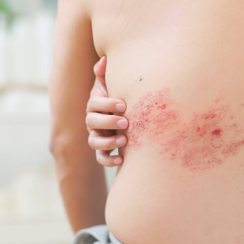 ‘I wouldn’t wish it on anyone’: What to know and do about shingles