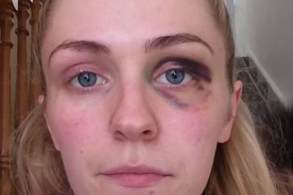 Emma Murphy: ‘He punched me ... It wasn’t the first time’