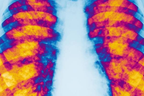 Cystic fibrosis drug could make disease a manageable condition