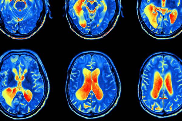 Public patient waits 120 days more than private one for brain scan