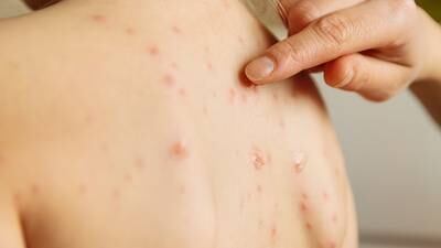 Chickenpox vaccine should be administered to children, Hiqa advises