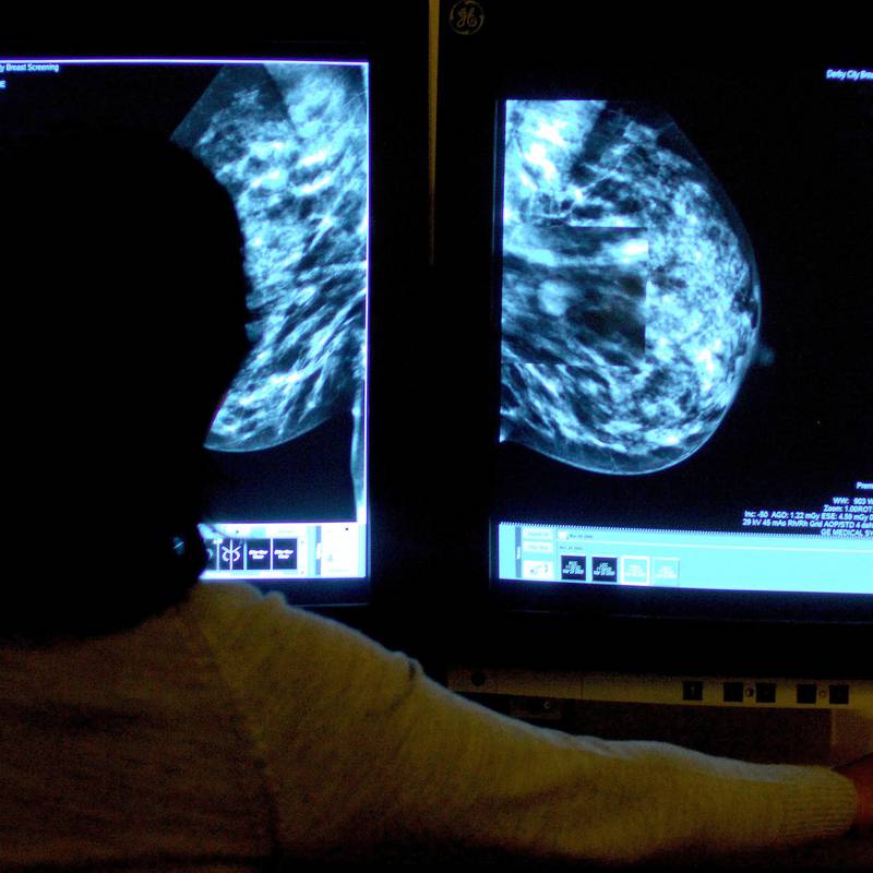 HSE approves new treatment option for people with breast cancer at high-risk of recurrence