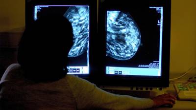 Mammography screening cuts breast cancer deaths by 40%