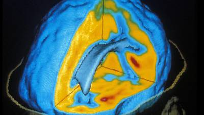 Scientists  successfully shut down brain swelling