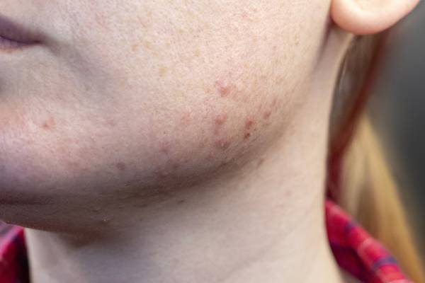 Acne: A serious problem that can appear in young children and even babies