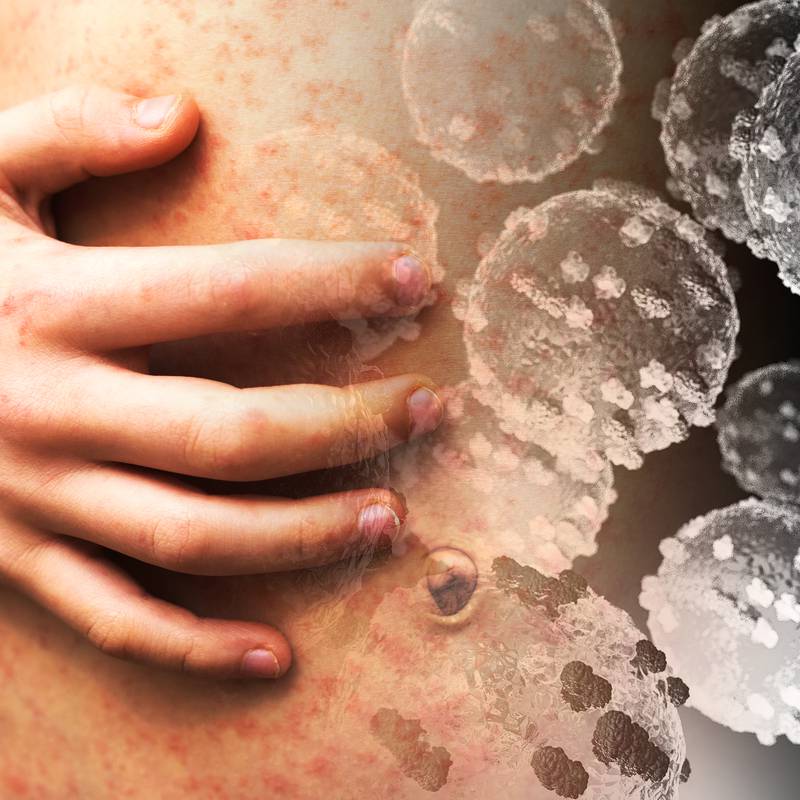 HSE issues ‘urgent alert’ for measles after case in Dublin indoor-play centre