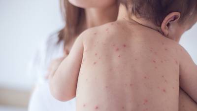 Ireland has lowest immunisation rate for measles in Western Europe, according to ECDC