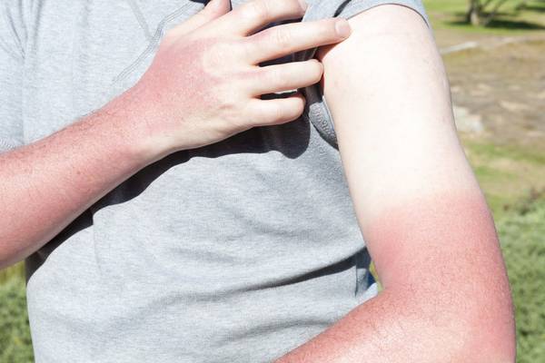 Sound Off: Missing a spot with the factor 50 is zero craic