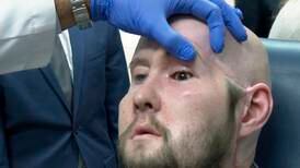 World’s first eye transplant performed on man who suffered electric shock