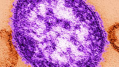Warning over  adult measles ‘outbreak’ in Co Cork