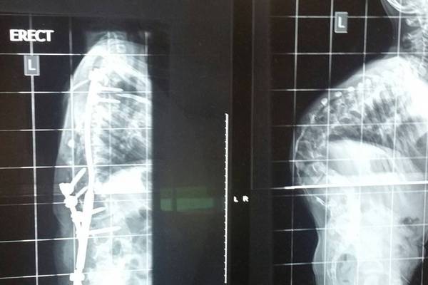 Children with scoliosis ‘will have to go abroad’ for operations