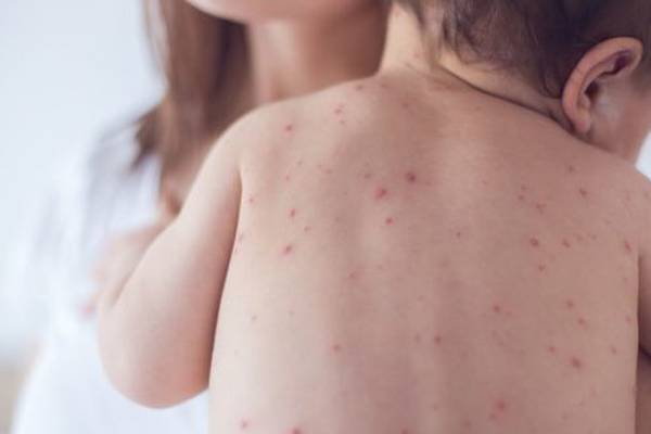 HSE confirms 15 cases of measles this year with 35 probable cases under investigation