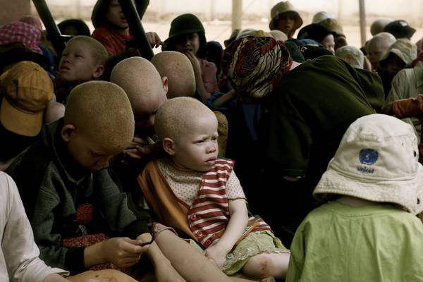 Irish clinicians shocked at murder of patient with albinism in Malawi