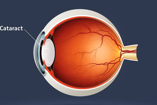 Did a cataract operation improve my memory?