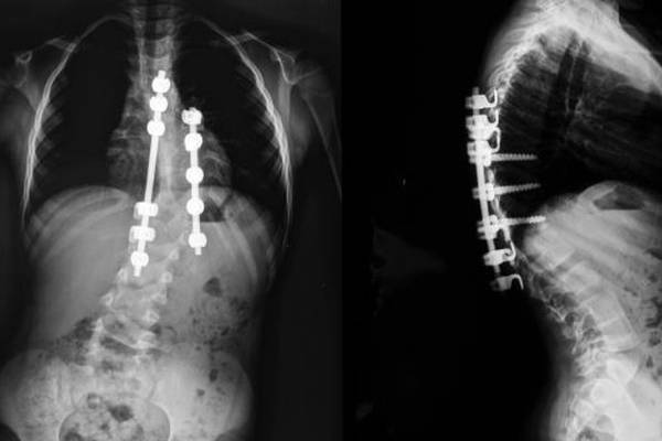 Living with scoliosis: ‘My life is on hold waiting for surgery’