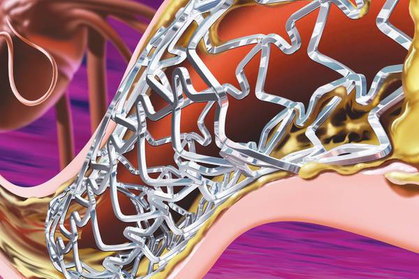 Are cardiac stents really the solution for heart problems?