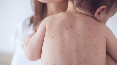 HSE confirms 15 cases of measles this year with 35 probable cases under investigation