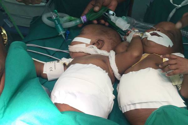 Irish surgeon separates conjoined twins in Tanzania
