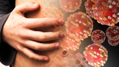 Sixth measles case confirmed by HPSC