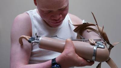Albino children attacked for body parts get new limbs in America