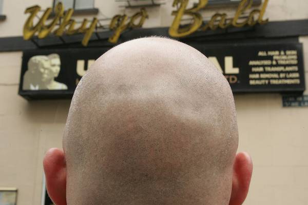 Fear of hair loss used to consume me. Now I don’t think it needs curing